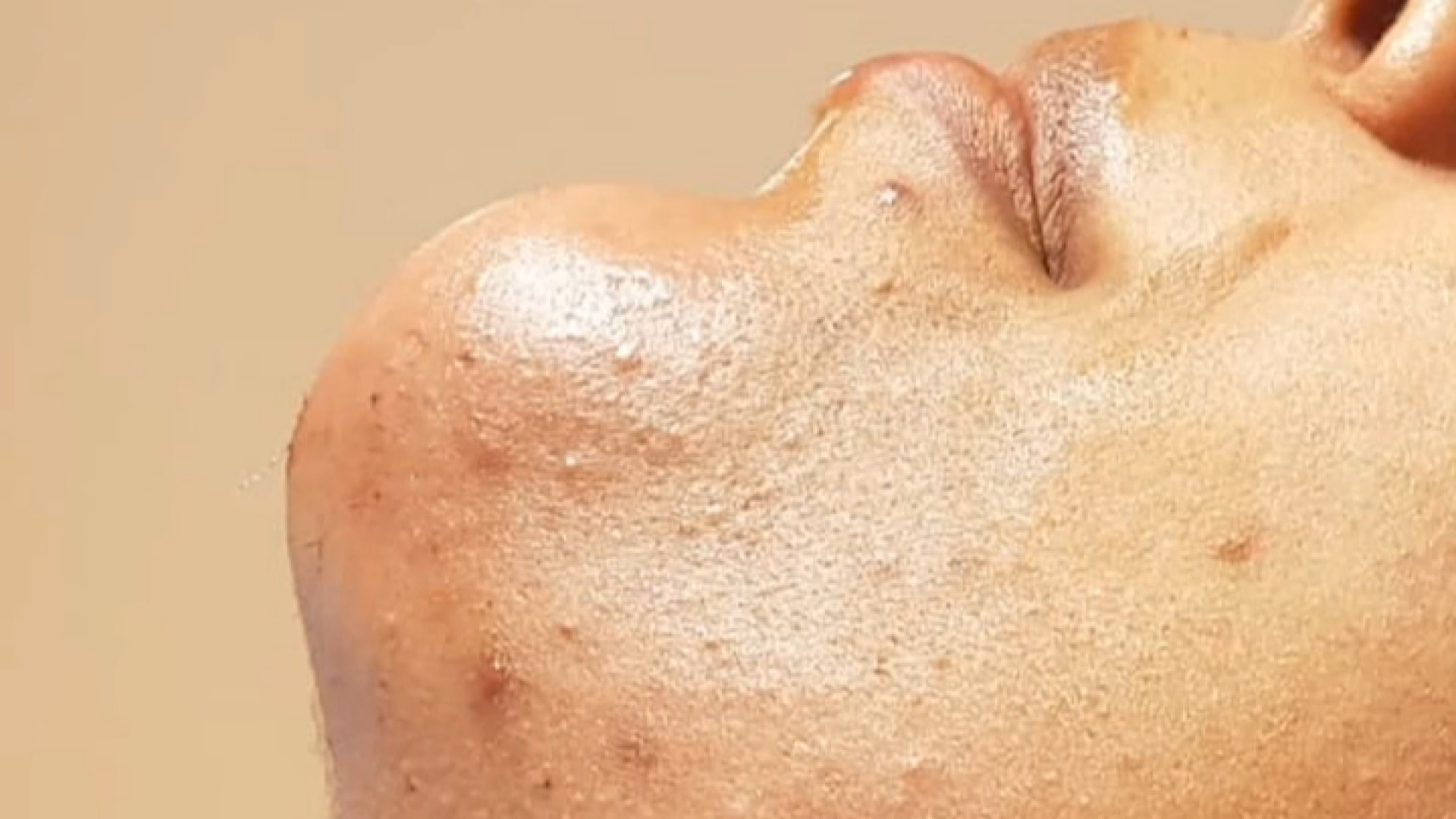 نتیجه جراحی ساکشن غبغب توسط دکتر برومند دکتر سهیل برومند