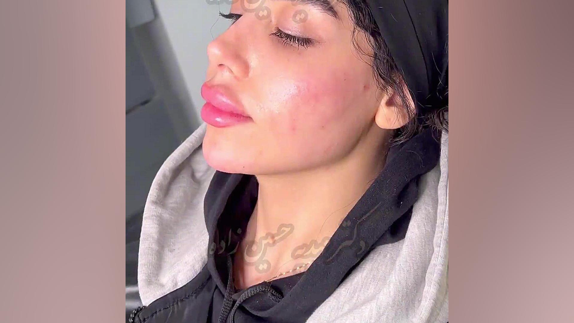 کانتورینگ صورت تزریق زاویه، چانه، گونه کلینیک زیبایی رشت کلینیک زیبایی رشت دکتر مهدیه حسین زاده