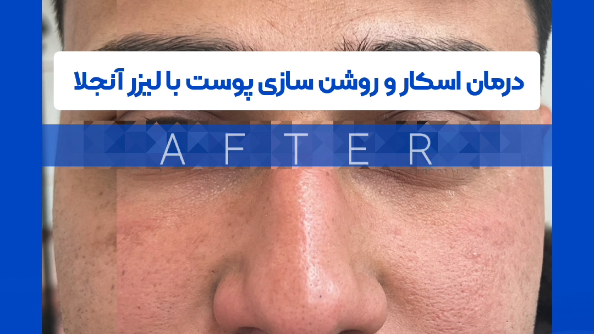 درمان اسکار پوستی و روشن سازی پوست با لیزر آنجلا -دکتر فرزانه دانش دکتر فرزانه دانش