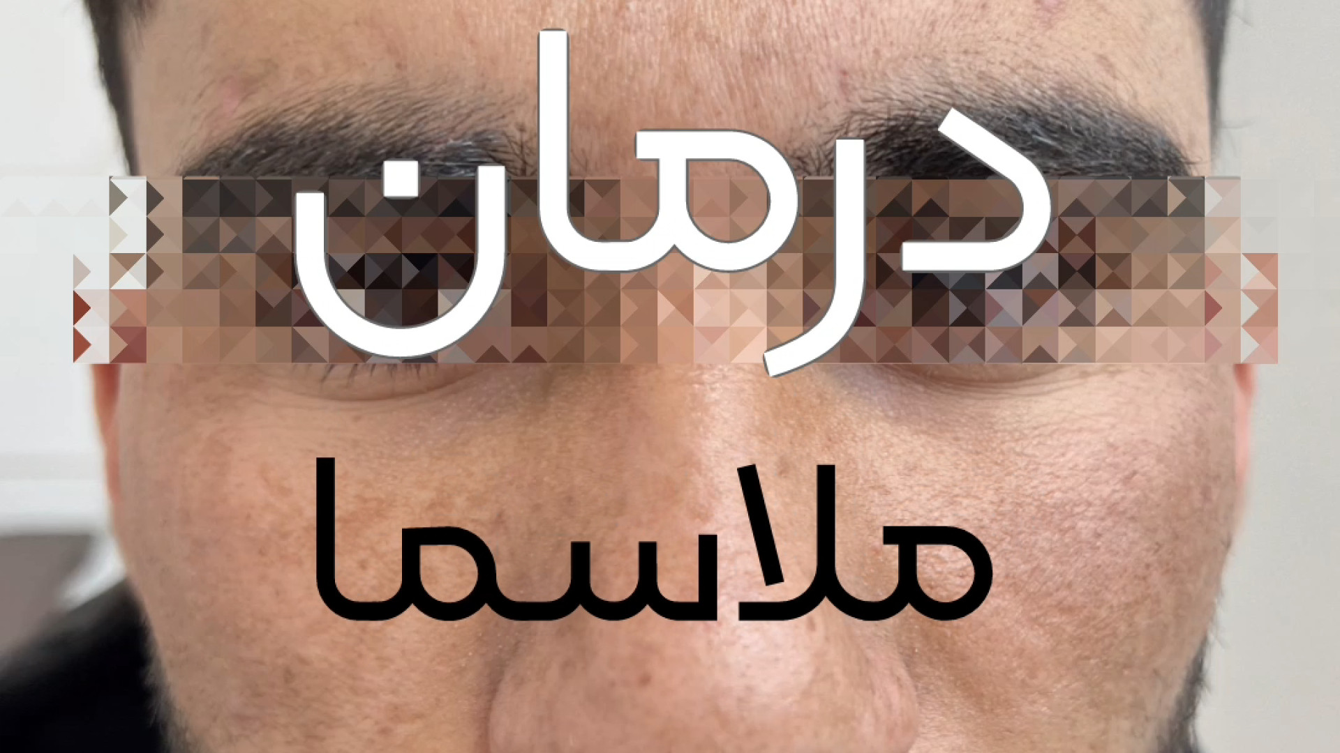 درمان ملاسما توسط دکتر فرزانه دانش متخصص پوست مو زیبایی و لیزر در اصفهان دکتر فرزانه دانش