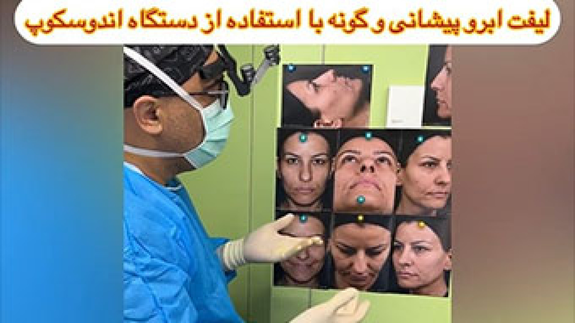 لیفت ابرو پیشانی و گونه با استفاده از دستگاه اندوسکوپ Live Cell Microscopy