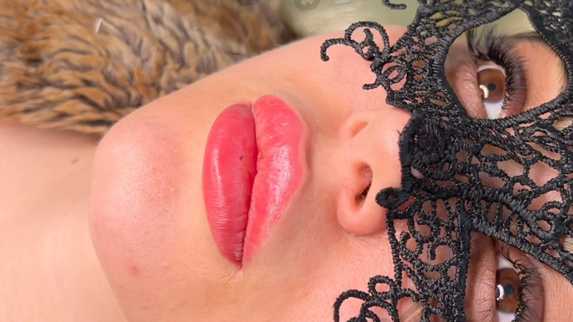 تزریق لبروسی رشت دکتر مهدیه حسین زاده،کلینیک زیبایی رشت کلینیک زیبایی رشت دکتر مهدیه حسین زاده