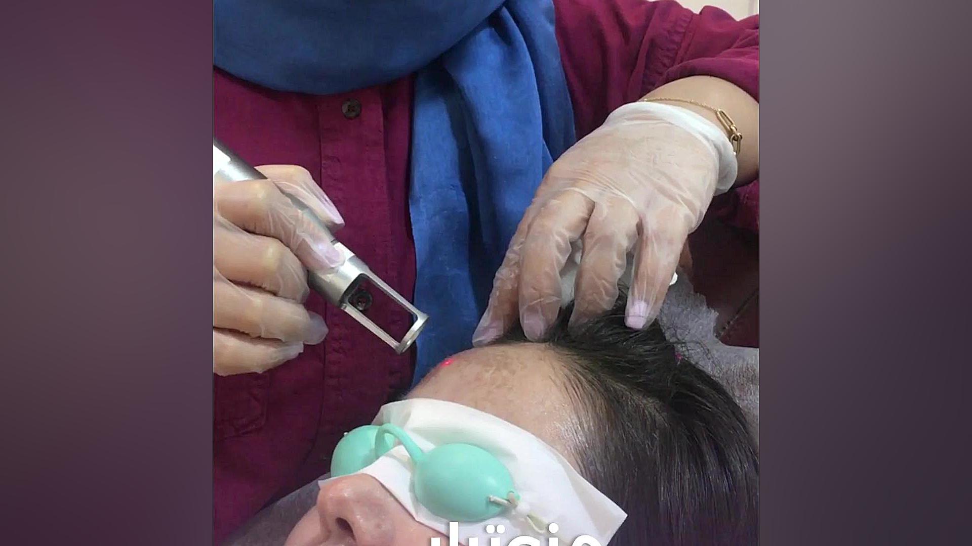 بر طرف کردن لک صورت در کلینیک لیان شیراز اصلاح طرح لبخند