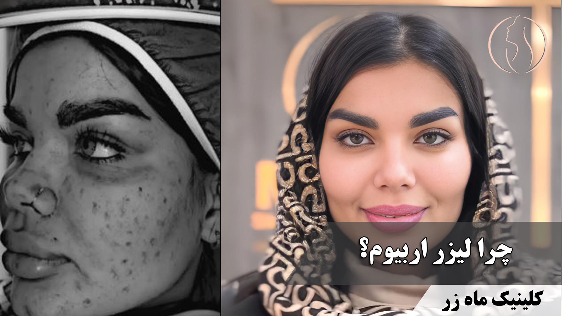 با جای جوشت خداحافظی کن ( کلینیک زیبایی ماه زر ) درمان ریزش مو