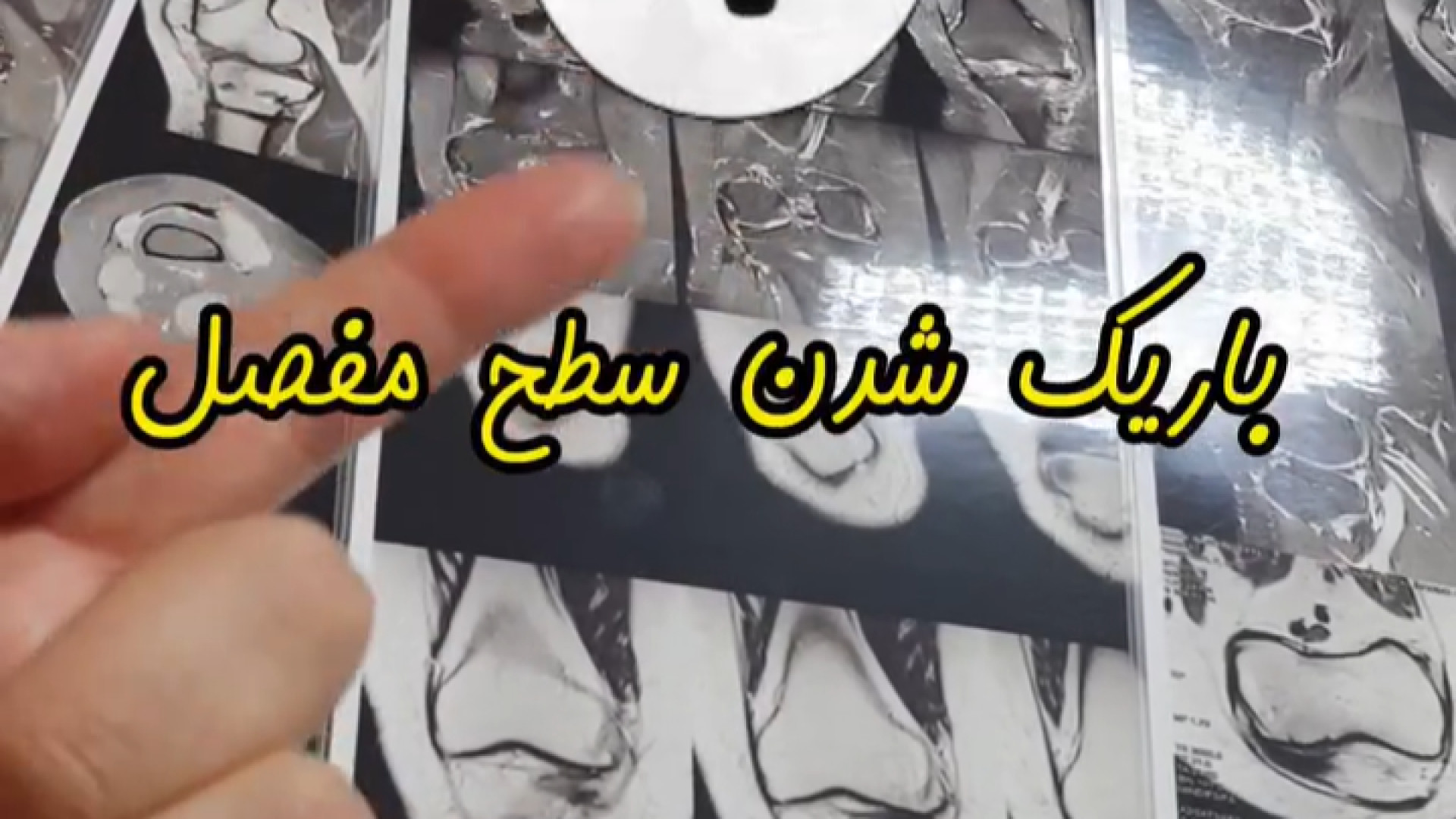 نشانه های آرتروز زانو در MRI ناتالی پورتمن
