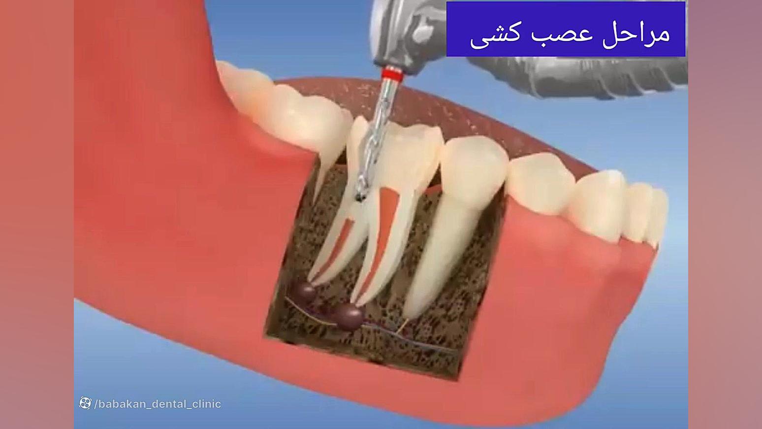 مراحل عصب کشی دندان کلینیک دندانپزشکی بابکان