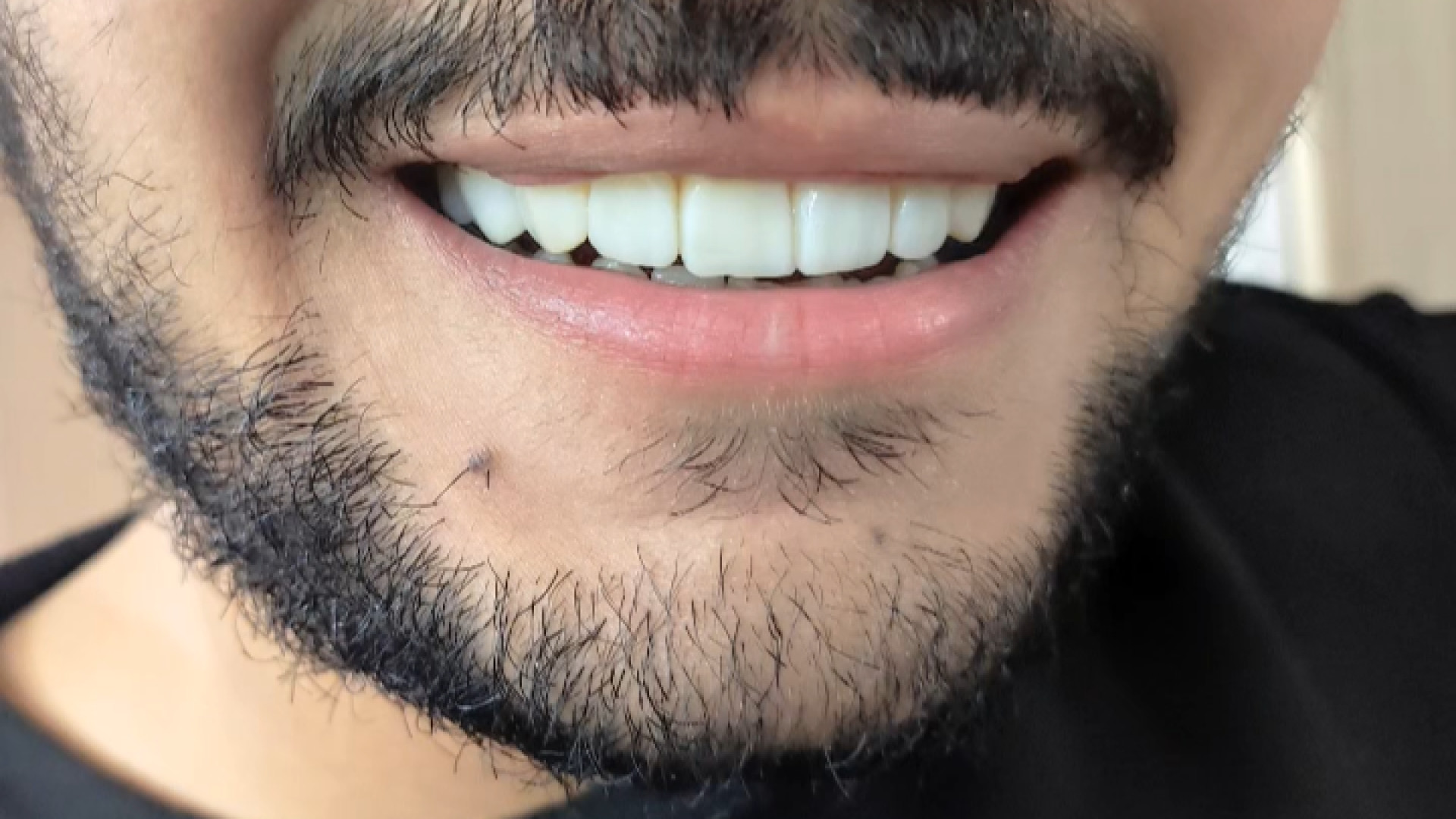 فالو کامپوزیت ونیر بعد دو سال بدون پالیش بدون ادیت دکتر زهرا رخ فروز