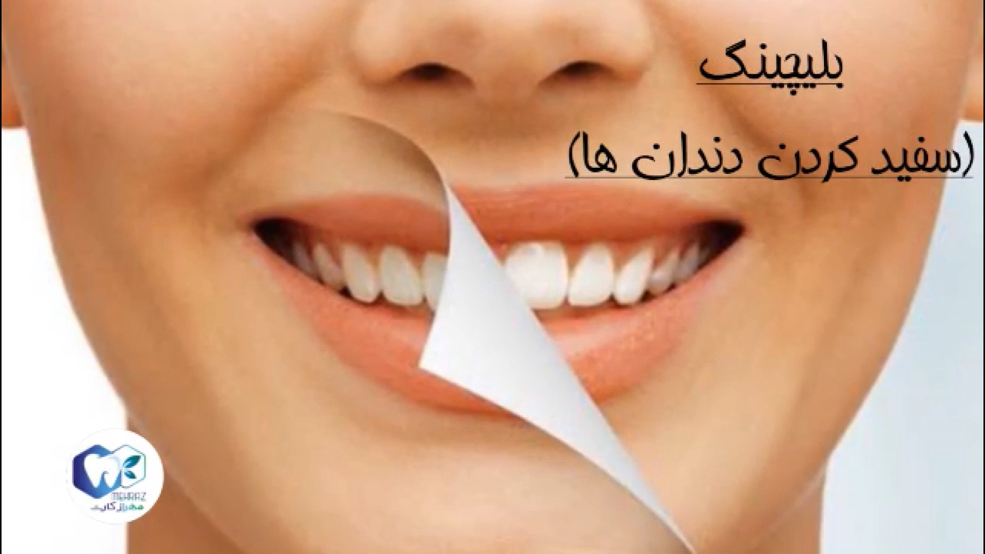 بلیچینگ دندان (سفید کردن دندان) PEFR
