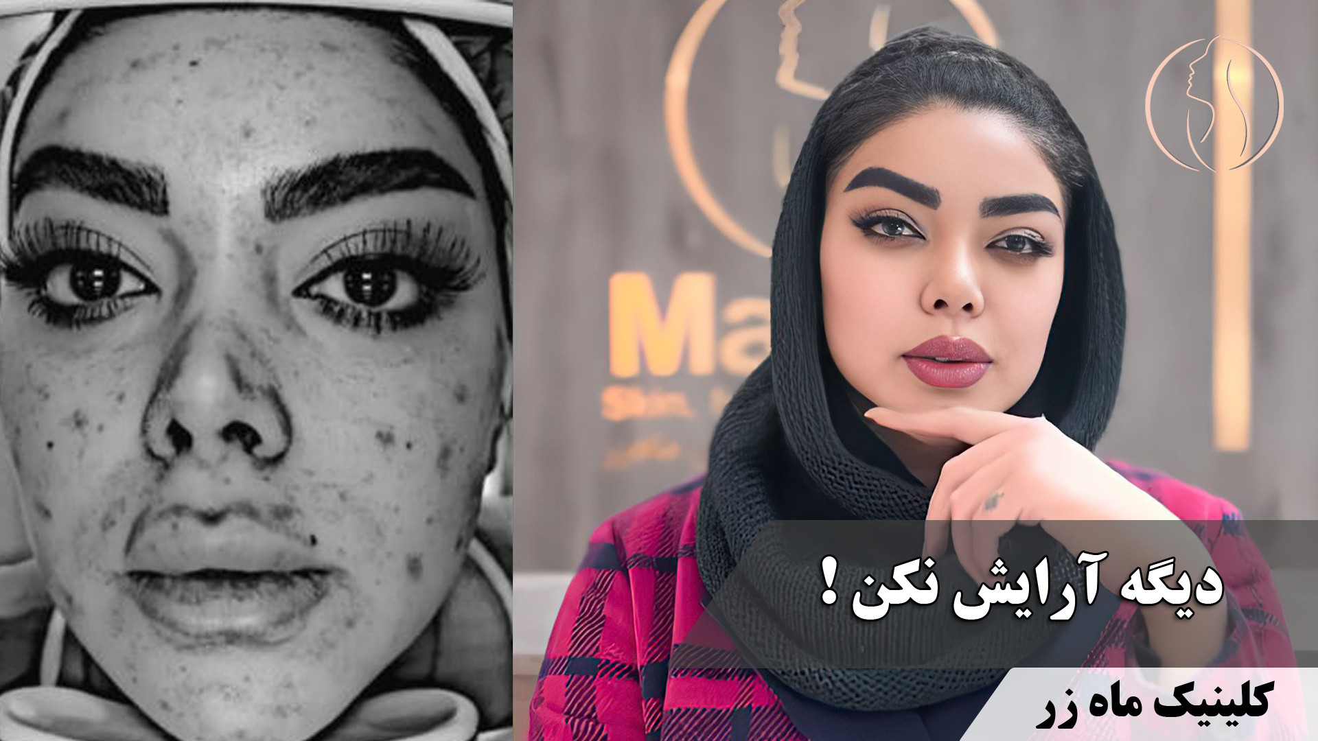 دیگه آرایش نکن! ( کلینیک زیبایی ماه زر ) عصب‌کشی