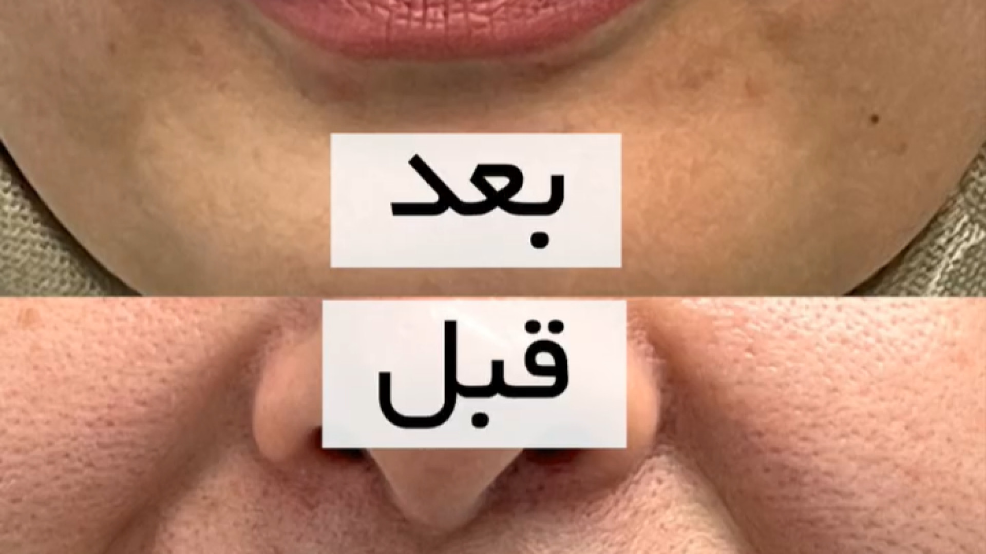 تزریق به خط خنده دکتر علیرضا بابایی،فوق تخصص جراحی پلاستیک و زیبایی