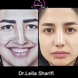 نمونه عمل بینی زنانه - عمل انحراف و کجی بینی - دکتر لیلا شریفی