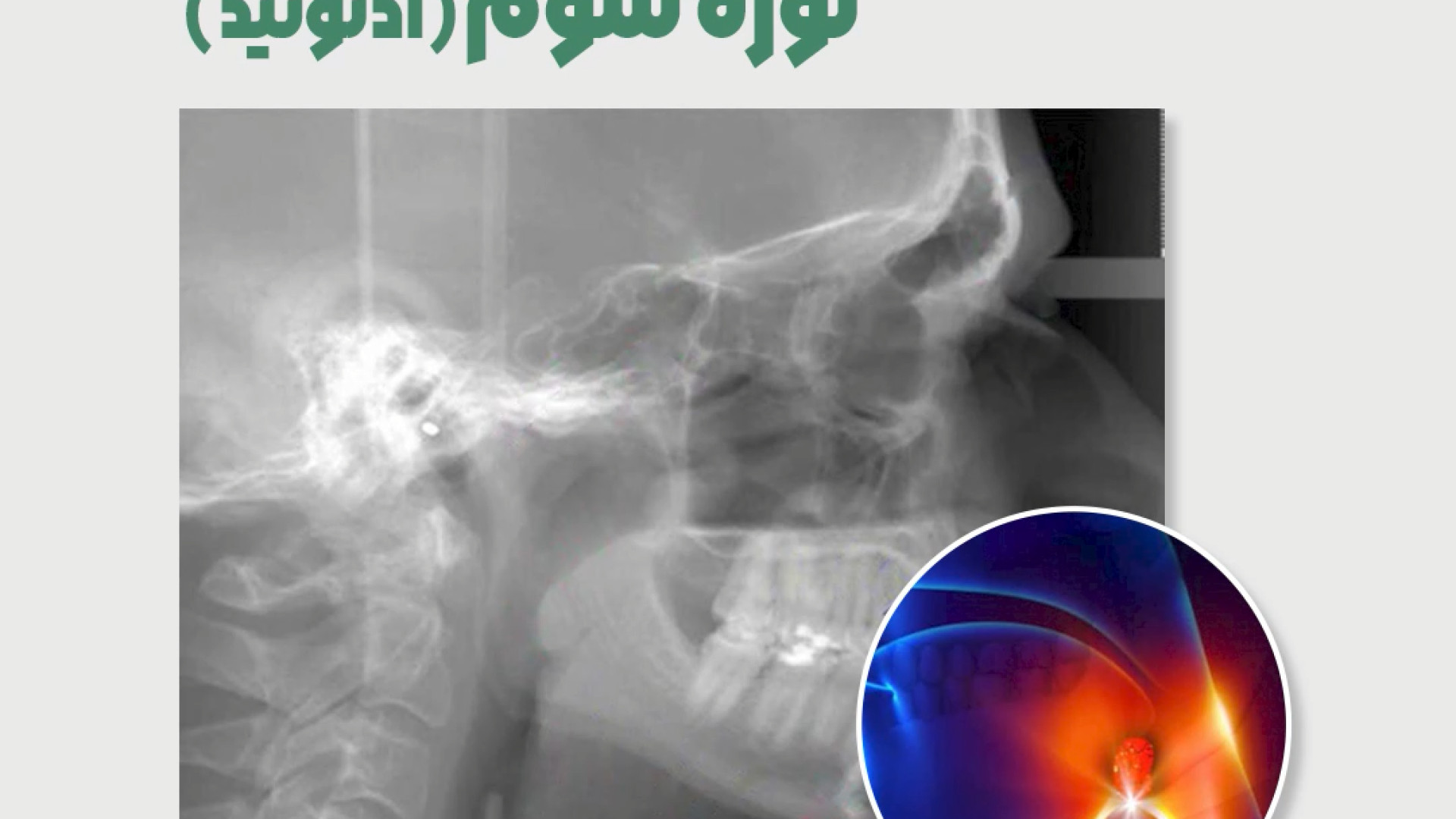 روش های معمول عکسبرداری از لوزه سوم (آدنوئید) رادیولوژی دهان، فک و صورت دکتر مریم زنگوئی بوشهری