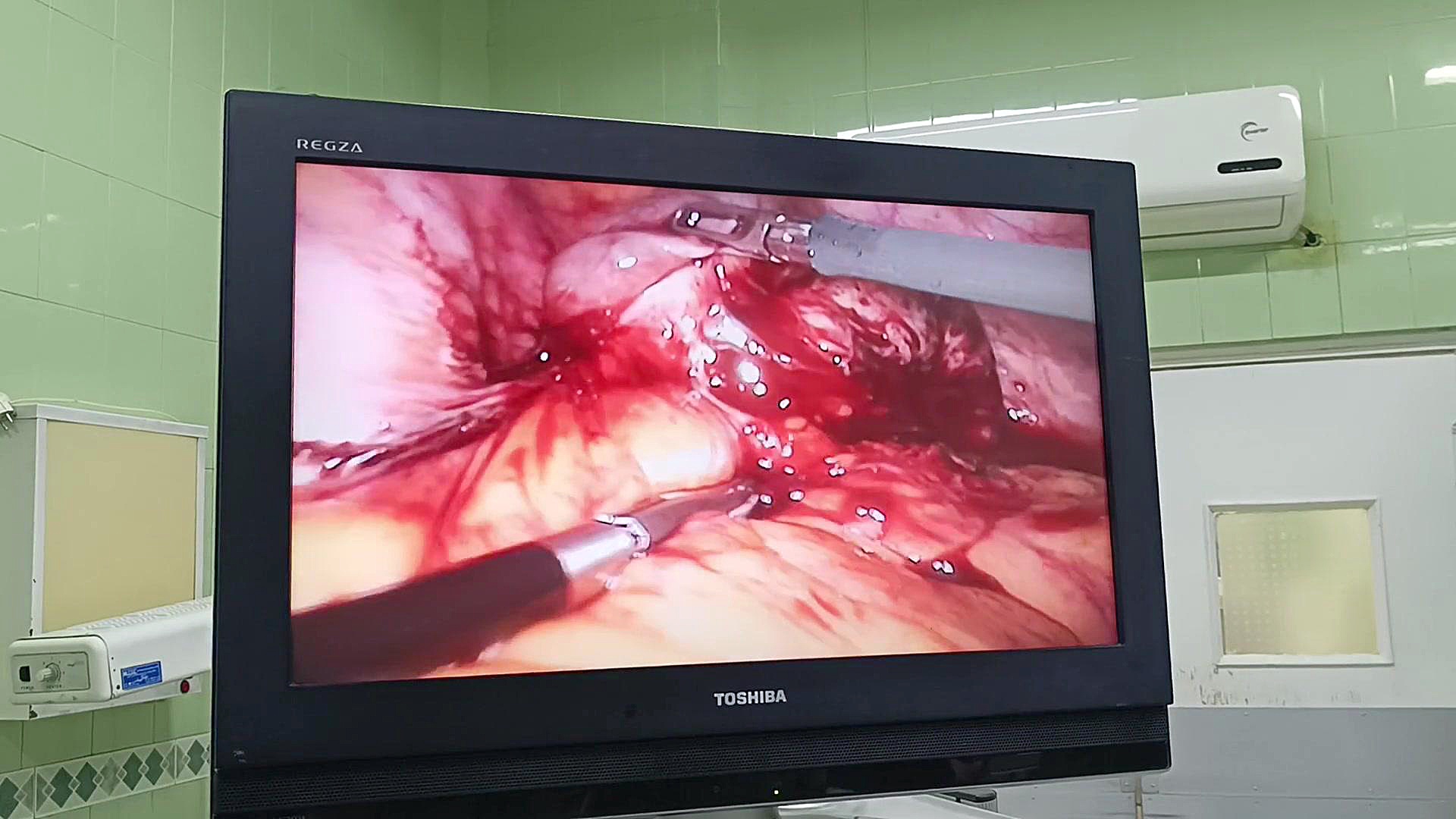 لاپاروسکوپی آندومتریوز دکتر فاطمه کریمی متخصص زنان و زایمان در قزوین