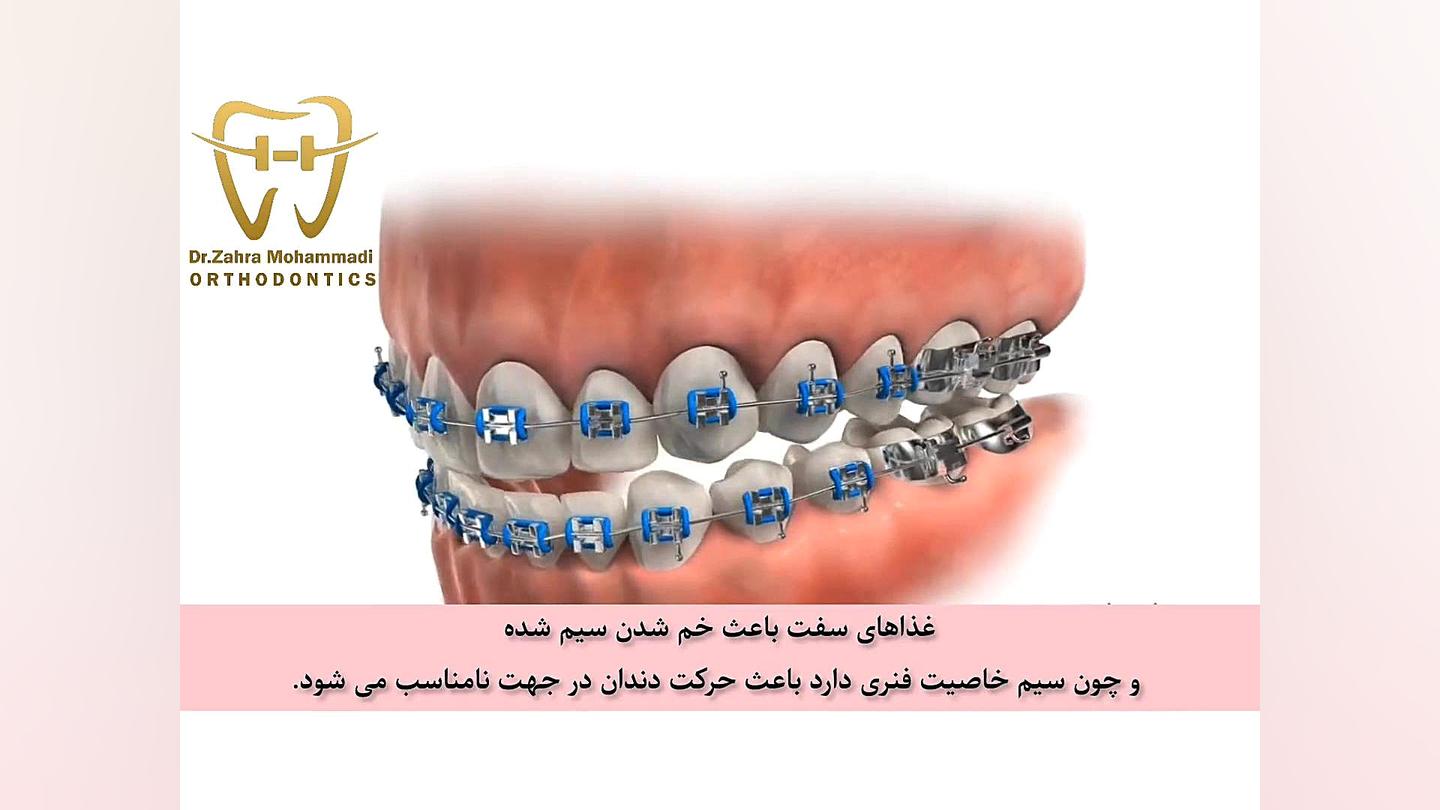 کنده شدن براکت دکتر زهرا محمدی :: متخصص ارتودنسی :: تهران-شهریار ::