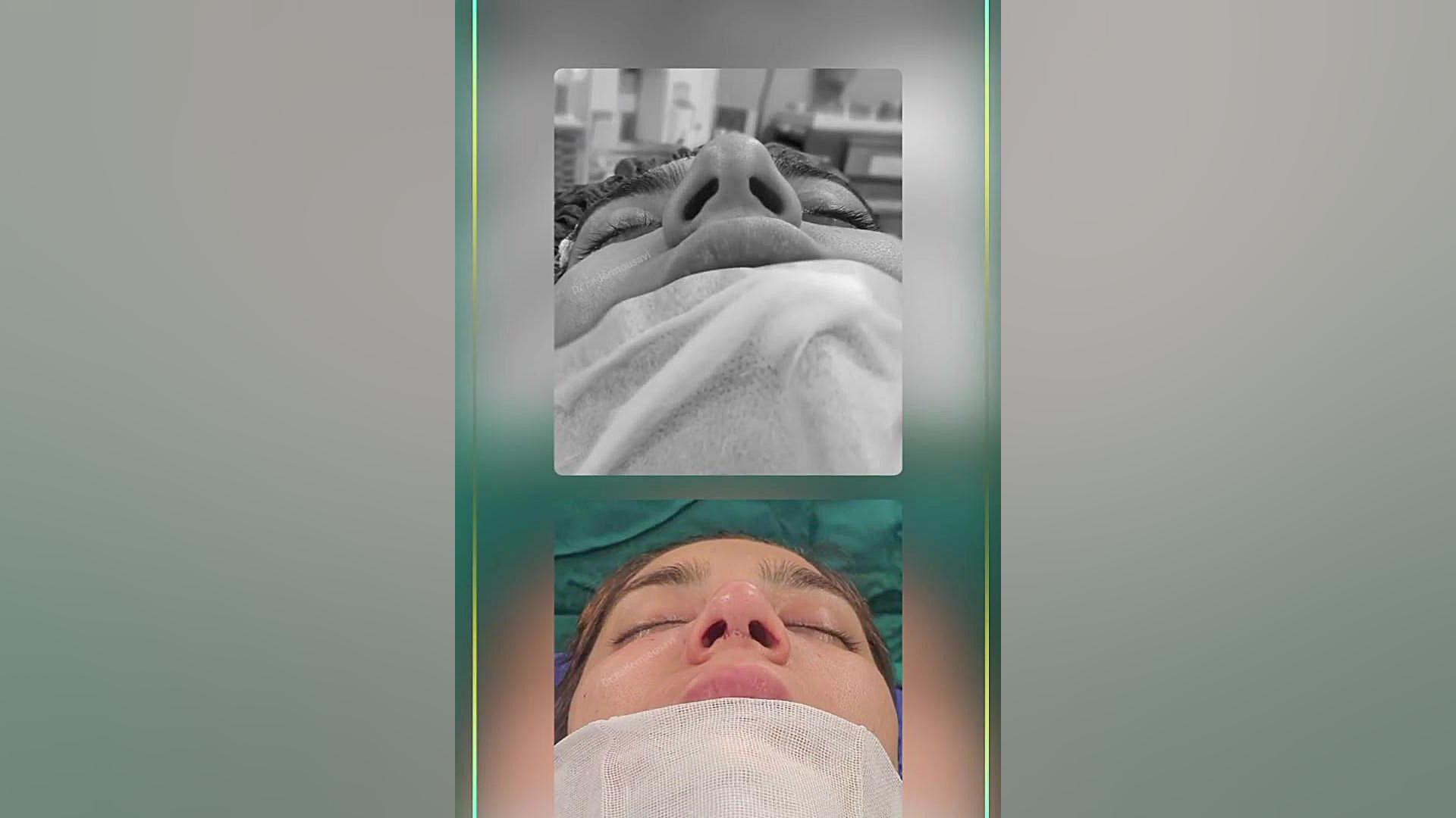 نتایج حاصل از جراحی زیبایی بینی در گچساران نوروجراحی فانکشنال