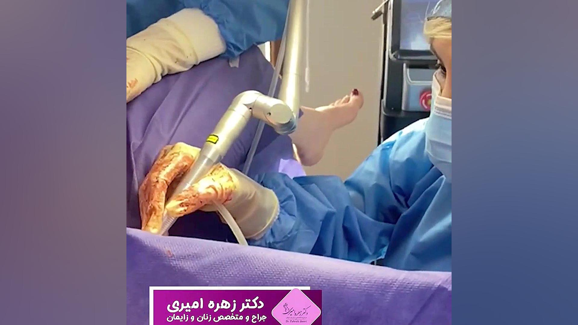 تنگی و لابیا پلاستی با لیزر دکتر زهره امیری