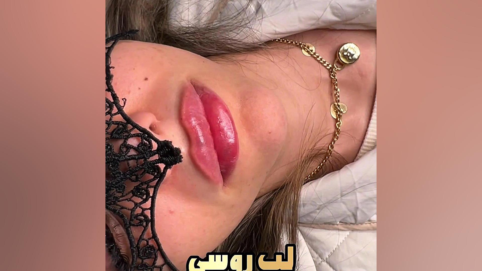 تزریق لب روسی رشت کلینیک زیبایی دکتر مهدیه حسین زاده کلینیک زیبایی رشت دکتر مهدیه حسین زاده