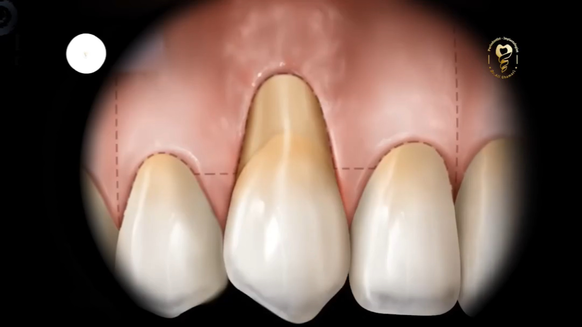 تحلیل لثه دکتر علی قمری - متخصص جراحی لثه و ایمپلنت