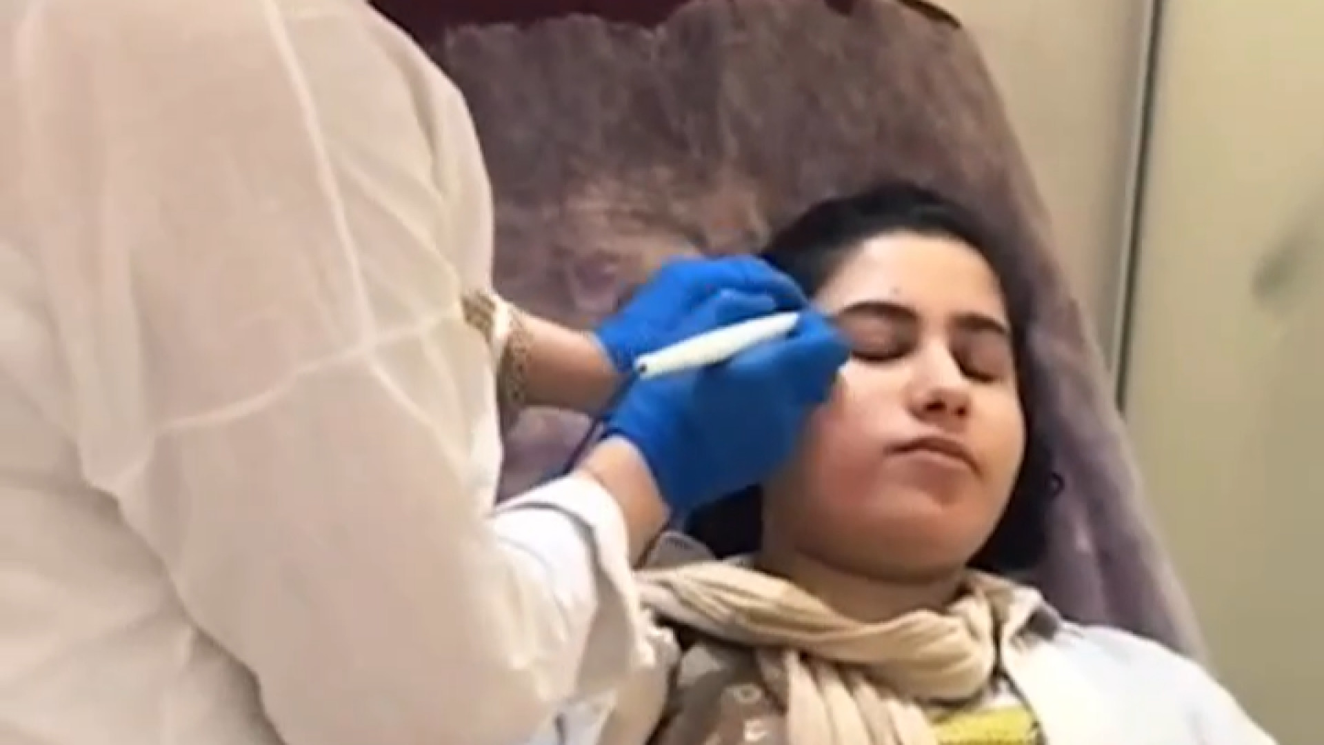 برداشت خالی های سطحی پوست صورت درمان جای جوش