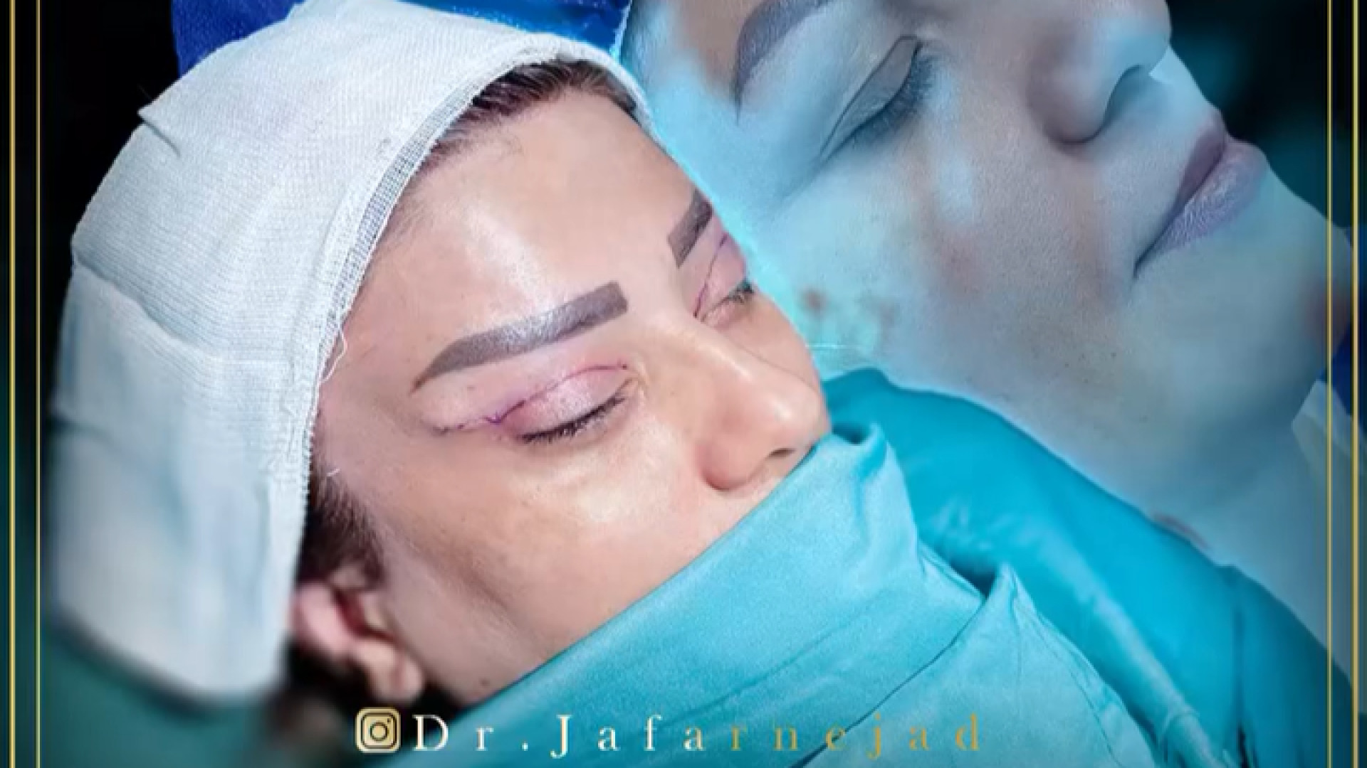 لیفت شقیقه و بلفاروپلاستی دکتر بابک جعفرنژاد