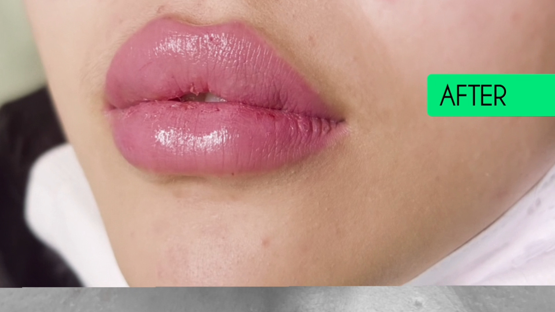 تزریق فیلر لب روسی دکتر فرزانه دانش