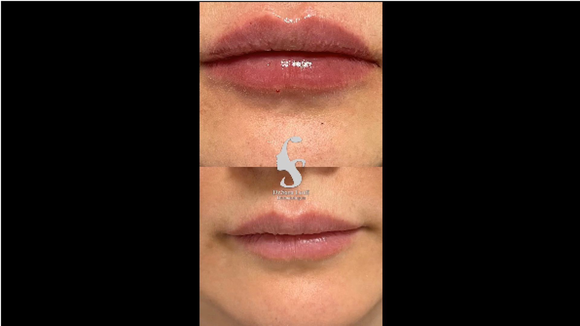 تزریق ژل لب دکتر سار ا لطفی