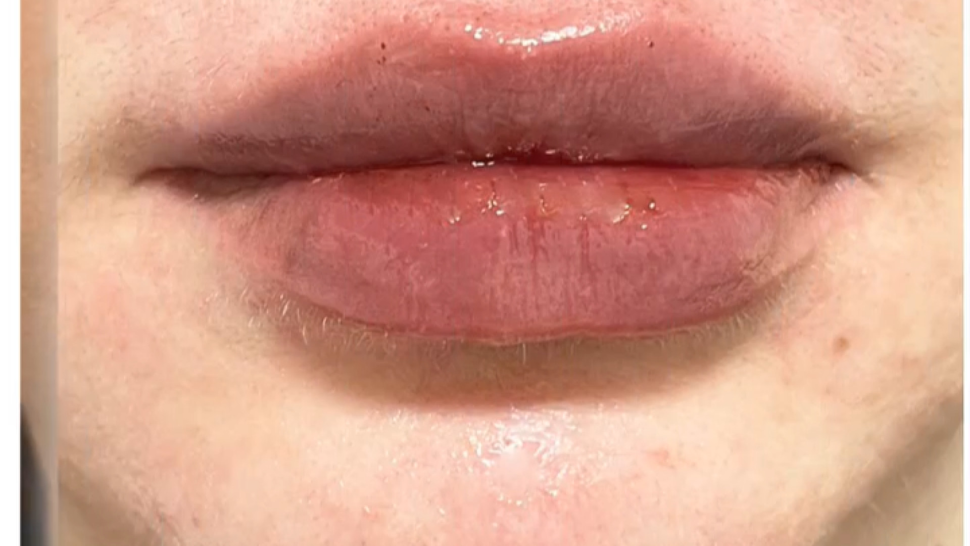 نتیجه فیلر لب دکتر سار ا لطفی