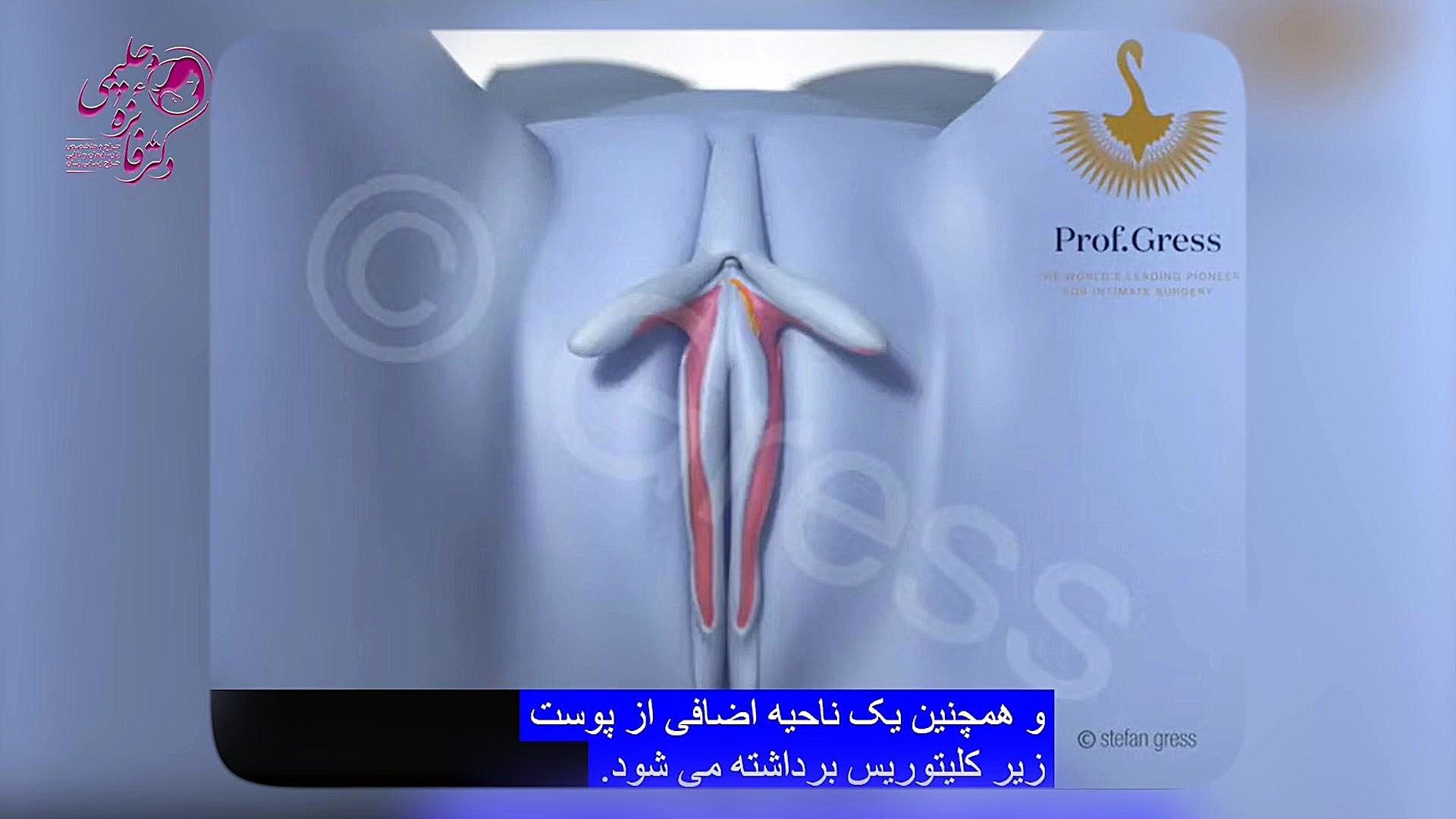 لابیا پلاستی دکتر فائزه حلیمی