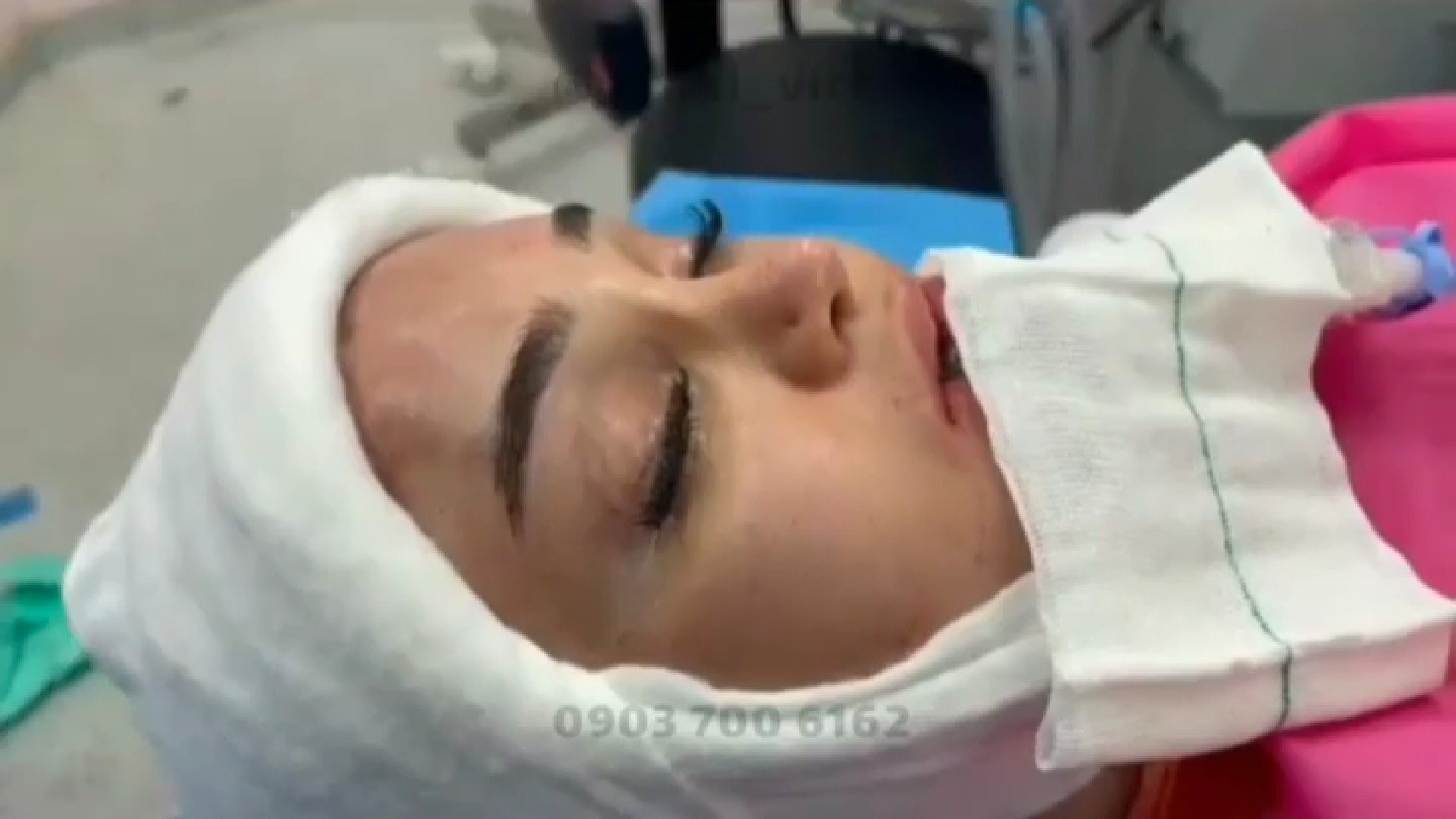 کوتاه کردن پیشانی و لیفت صورت در اتاق عمل ویکتوریا کاندسارتان
