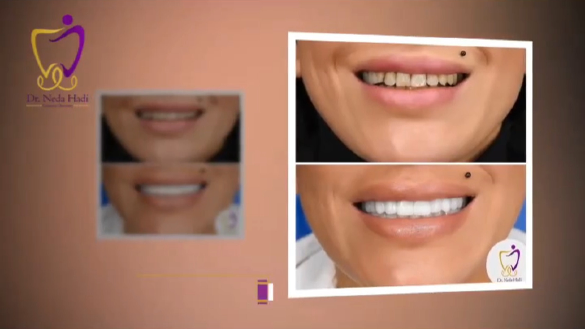 نمونه کار طراحی لبخند دکتر ندا هادی-دندانپزشک زیبایی