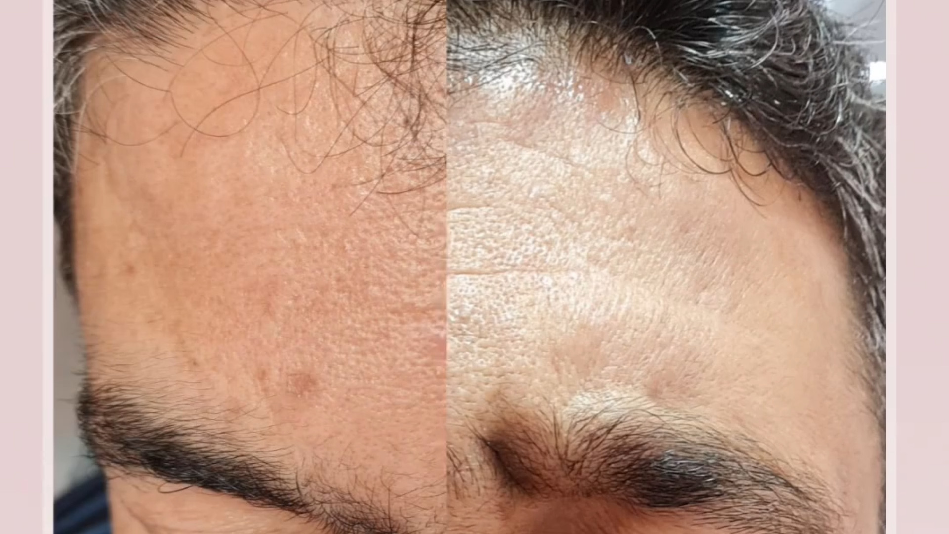 نتیجه تزریق بوتاکس و فیلر پیشانی مراجعه کننده عزیز دکتر مریم بیکی - پوست و مو و زیبایی اراک