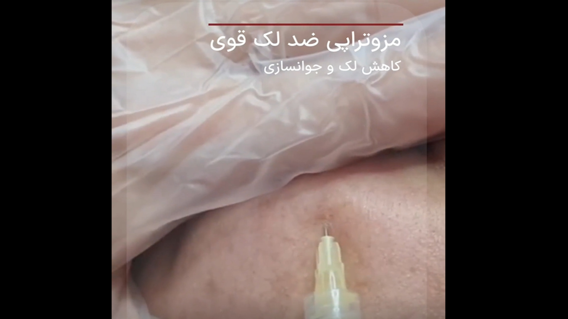 تاثیر تنها یک جلسه مزوتراپی ضد لک قوی دکتر مریم بیکی - پوست و مو و زیبایی اراک