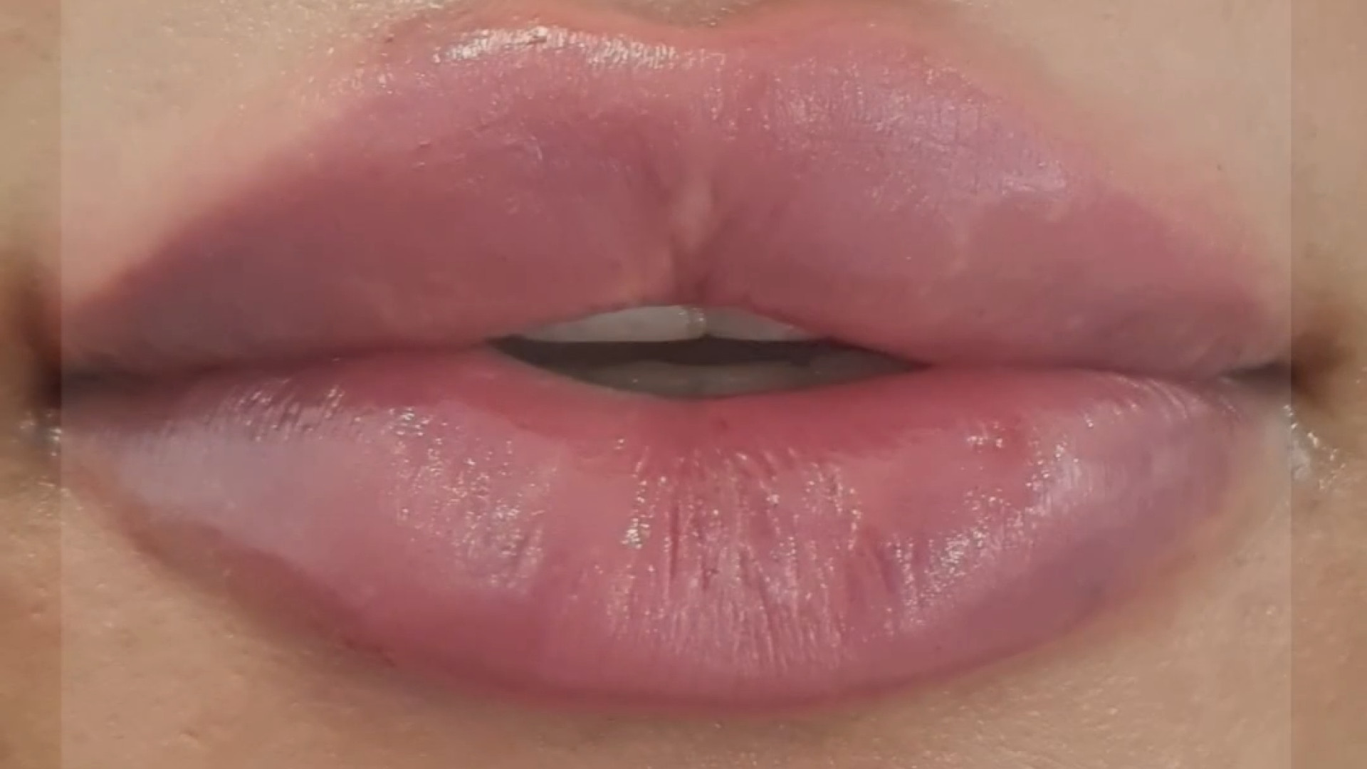 تزریق فیلر لب دکتر مریم بیکی - پوست و مو و زیبایی اراک