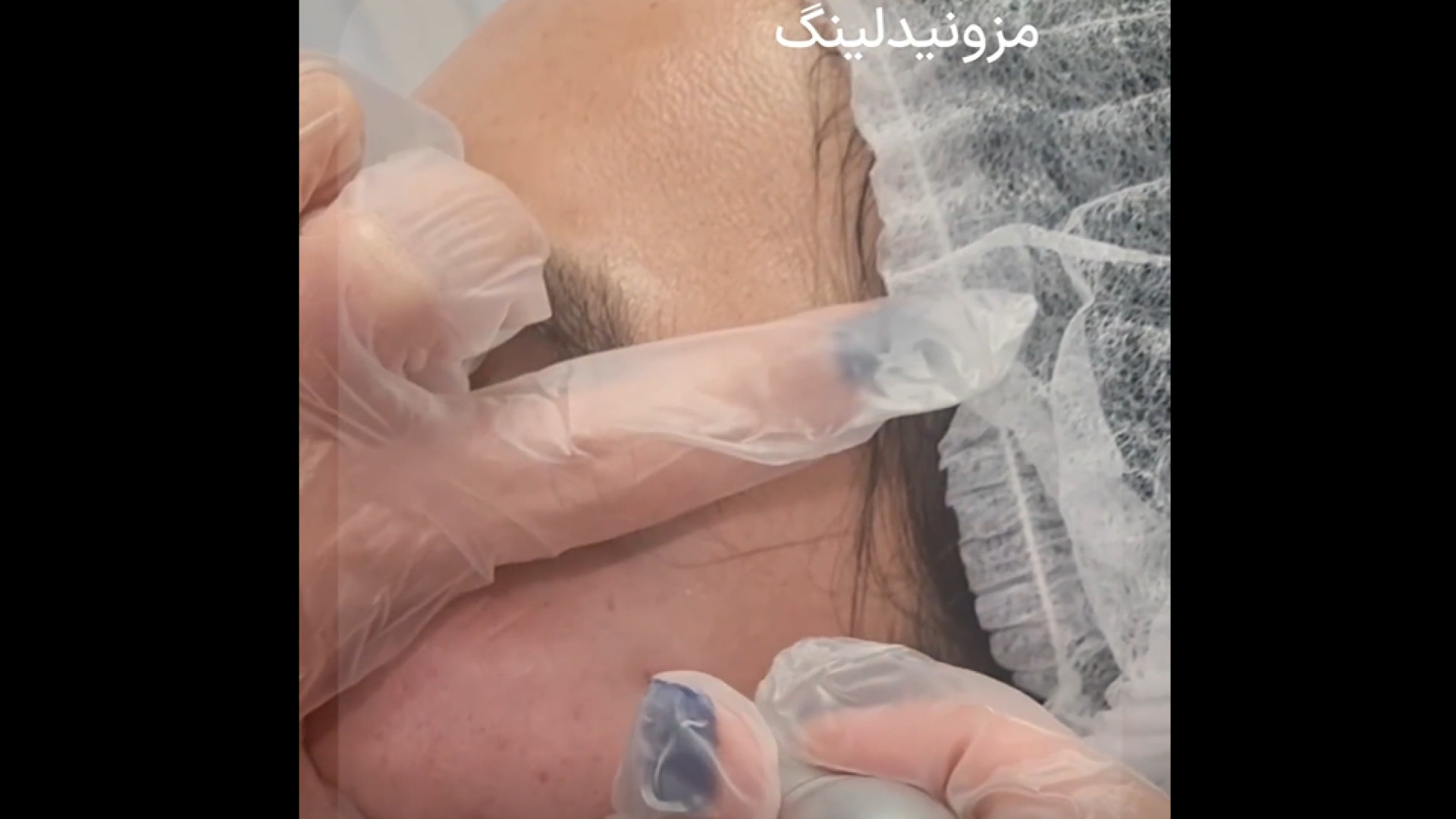 ️مزونیدلینگ دکتر مریم بیکی - پوست و مو و زیبایی اراک