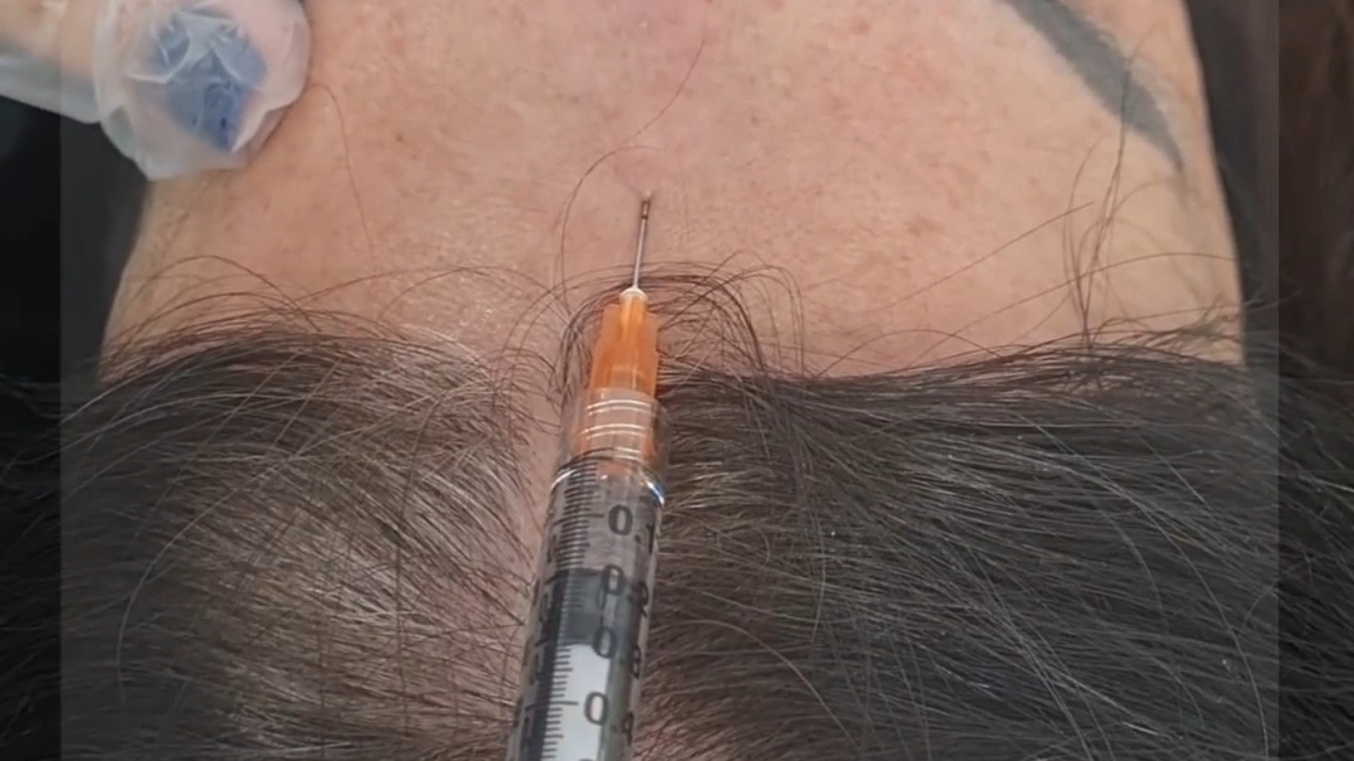 تزریق بوتاکس خط و اخم پیشانی دکتر مریم بیکی - پوست و مو و زیبایی اراک