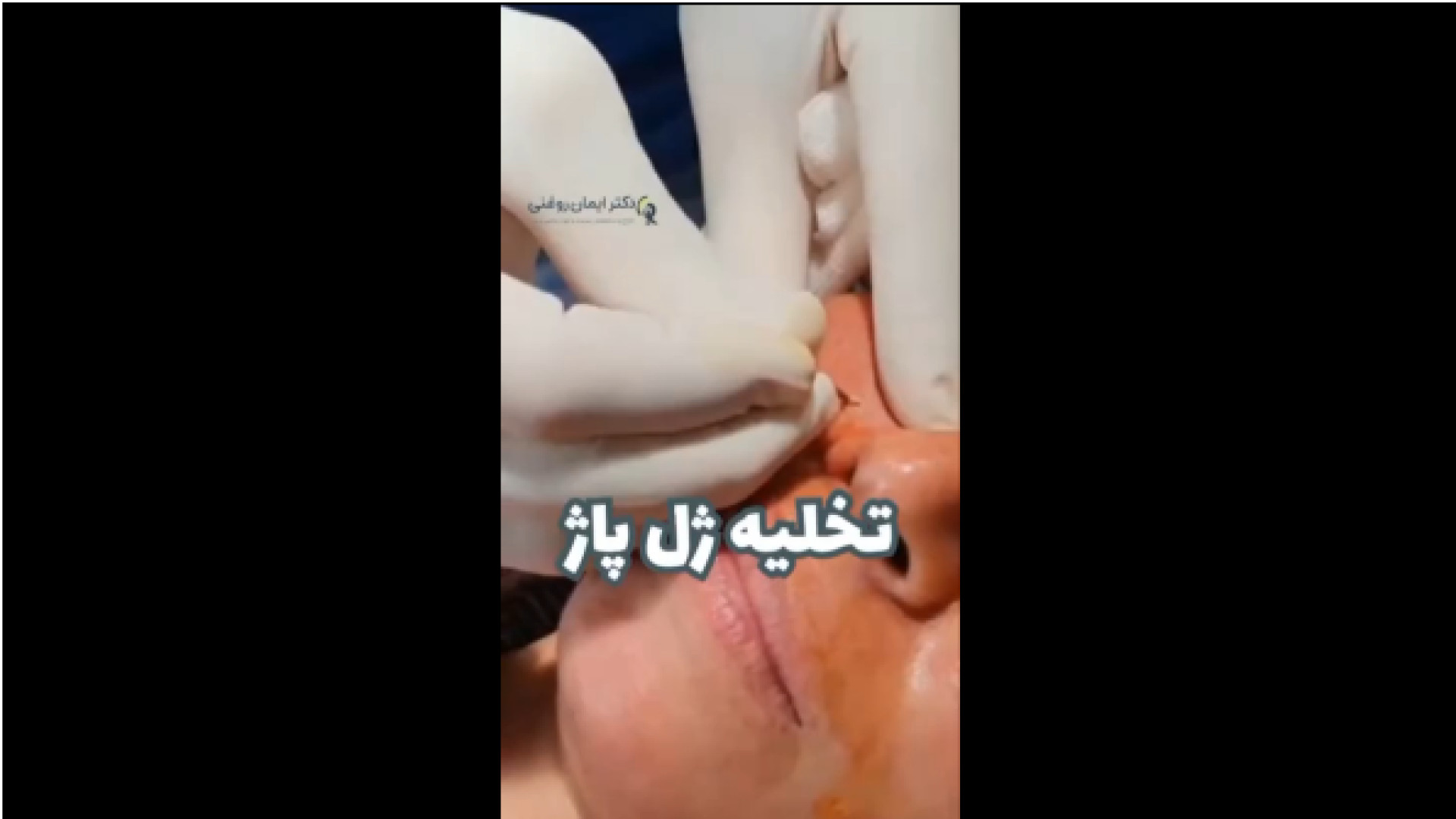 تخلیه ژل پاژ دکتر ایمان روغنی جراح و متخصص پوست و مو