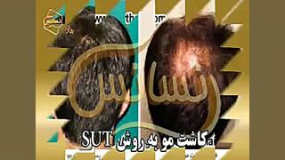 پیوند مو به روش SUT مرکز تخصصی موی رنسانس آر اف فرکشنال