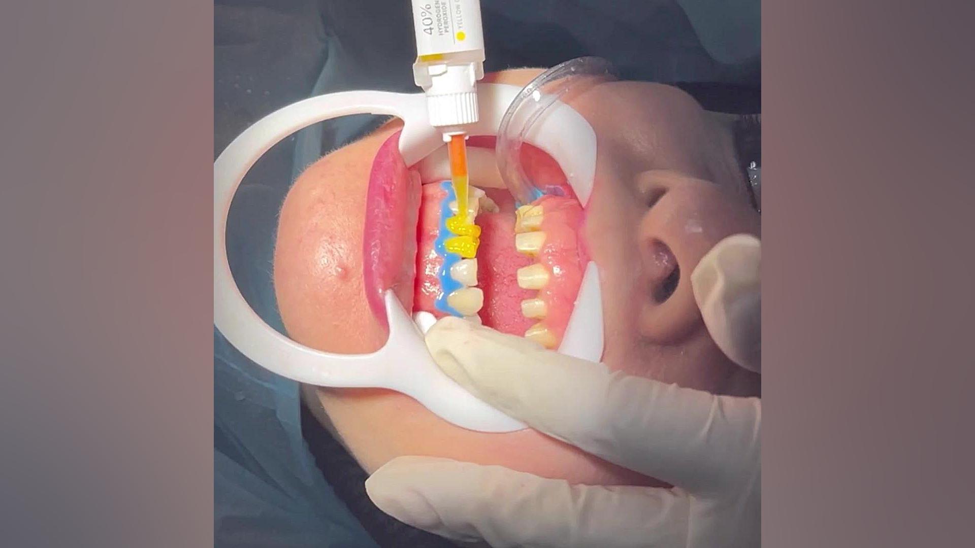 انجام بلیچینگ دندان bleaching teeth در کلینیک تخصص دکتر پورذکریا رانولازین