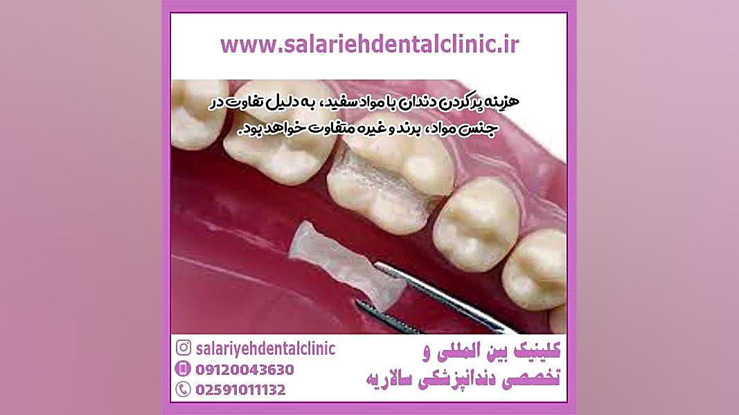 قیمت پر کردن دندان با مواد سفید اوتیلومیومبر