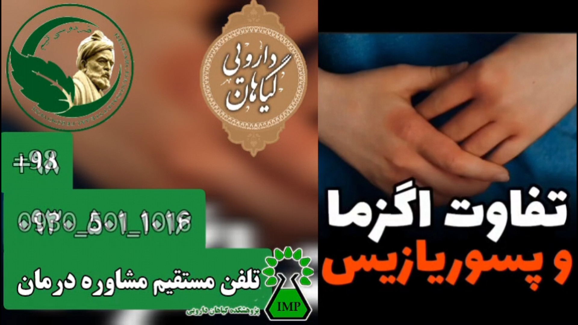 تفاوت بین اگزما و پسوریازیس صدف پوستی Psoriasis کریس ایوانز