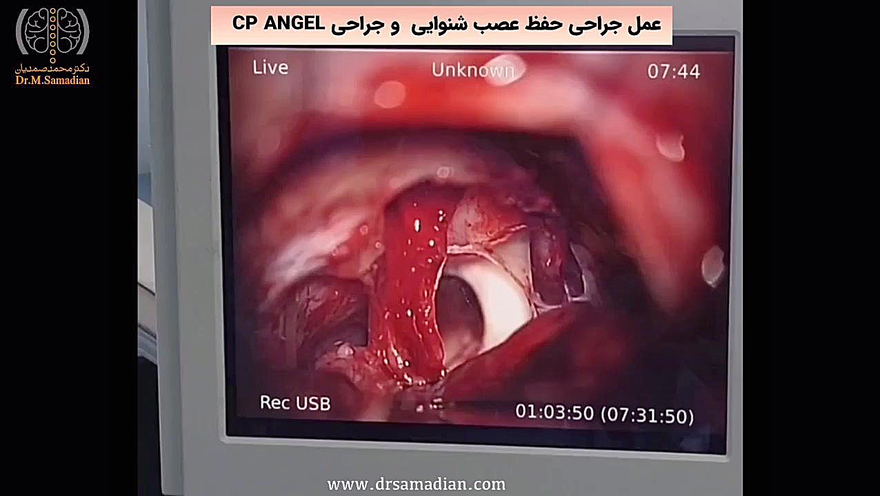 عمل جراحی حفظ عصب شنوایی و جراحی CP ANGELبیمار آقای 38 ساله برداشتن خال گوشتی