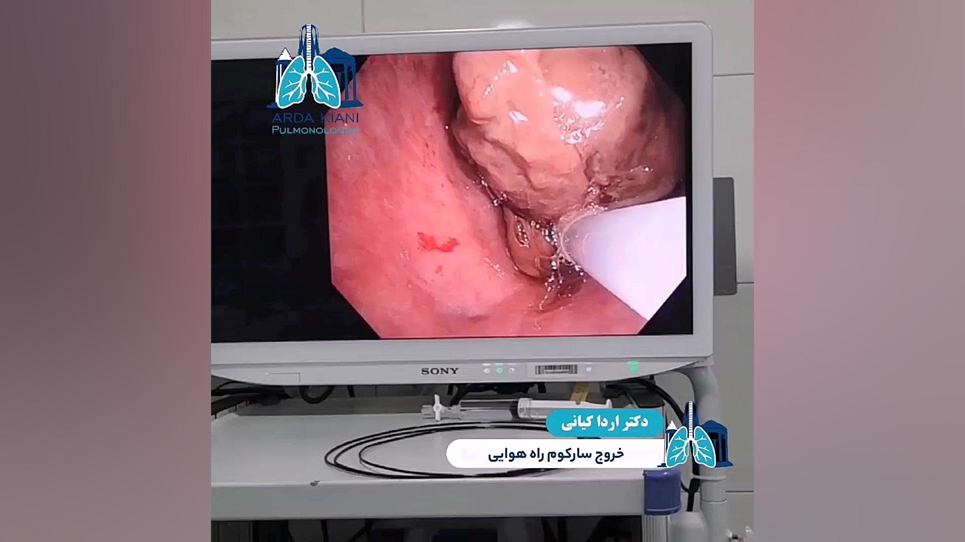خروج سارکوم راه هوایی به روش برونکوسکوپی دکتر اردا کیانی