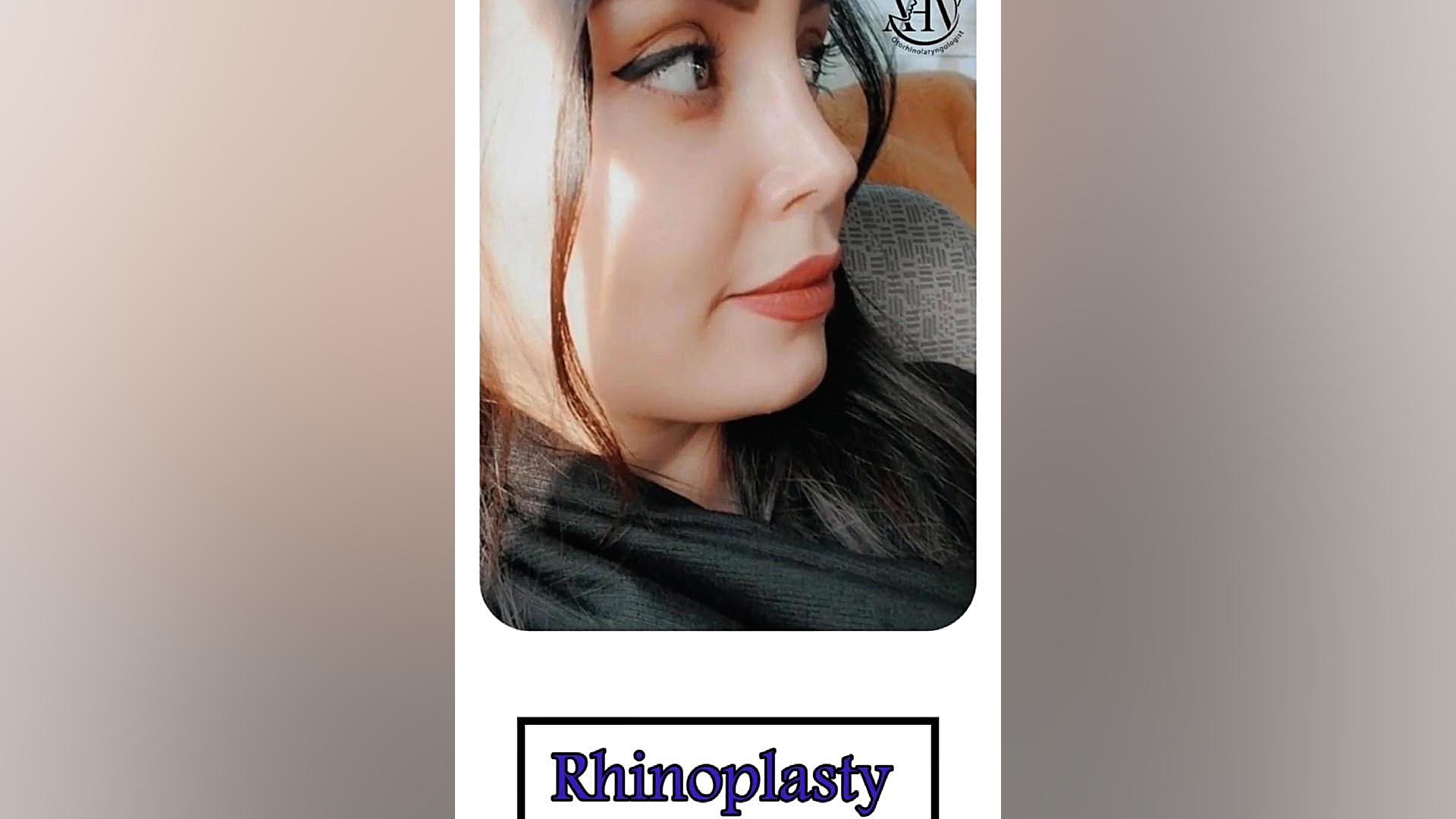 نتیجه عمل بینی | دکتر علی واجاری دکتر علی حسینی واجاری - جراح بینی رشت