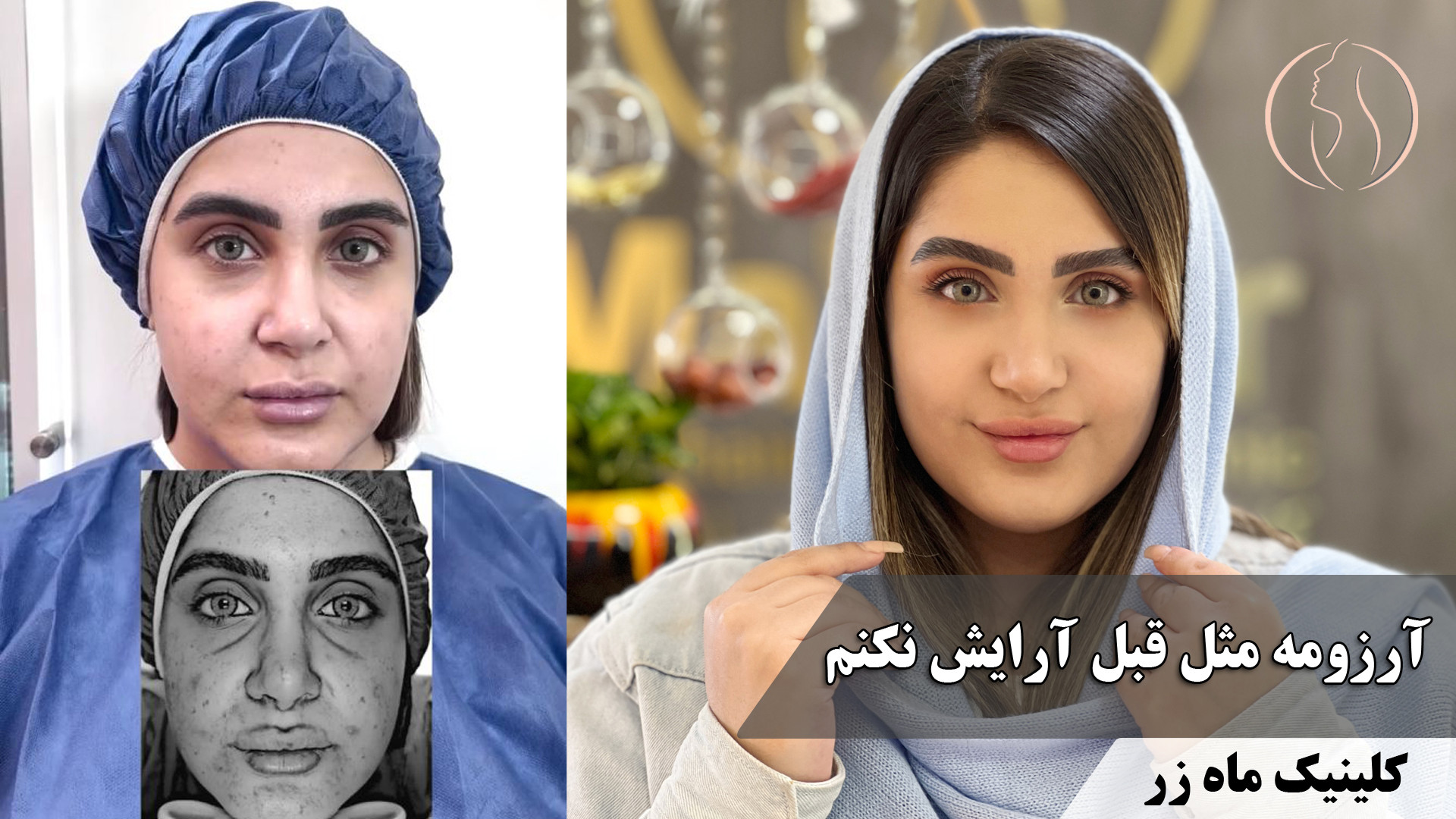 لیزر اربیوم یک فناوری پیشرفته ( کلینیک زیبایی ماه زر ) آزمون ایمونوفیکساسیون