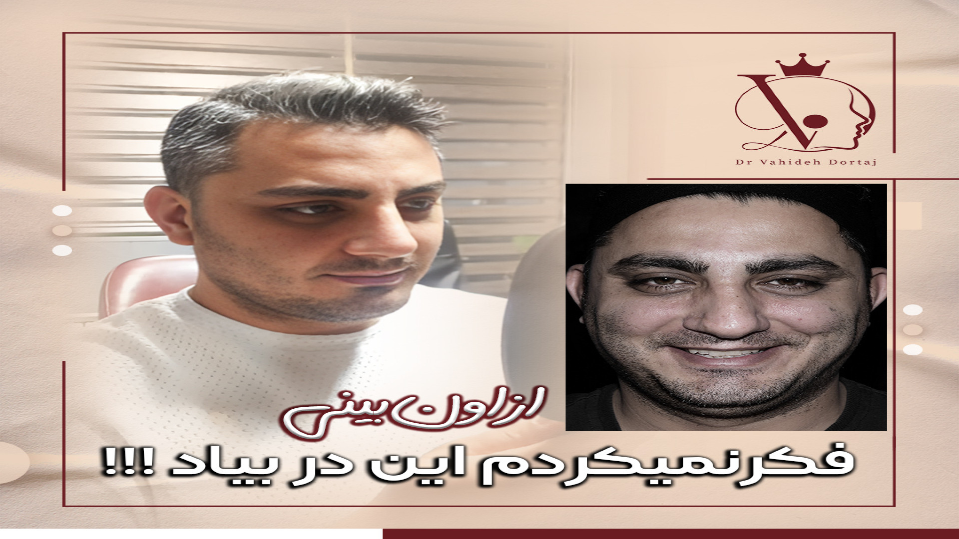 نتیجه فوق العاده جراحی زیبایی بینی تحت نظر دکتر درتاج جراحی پف زیر چشم