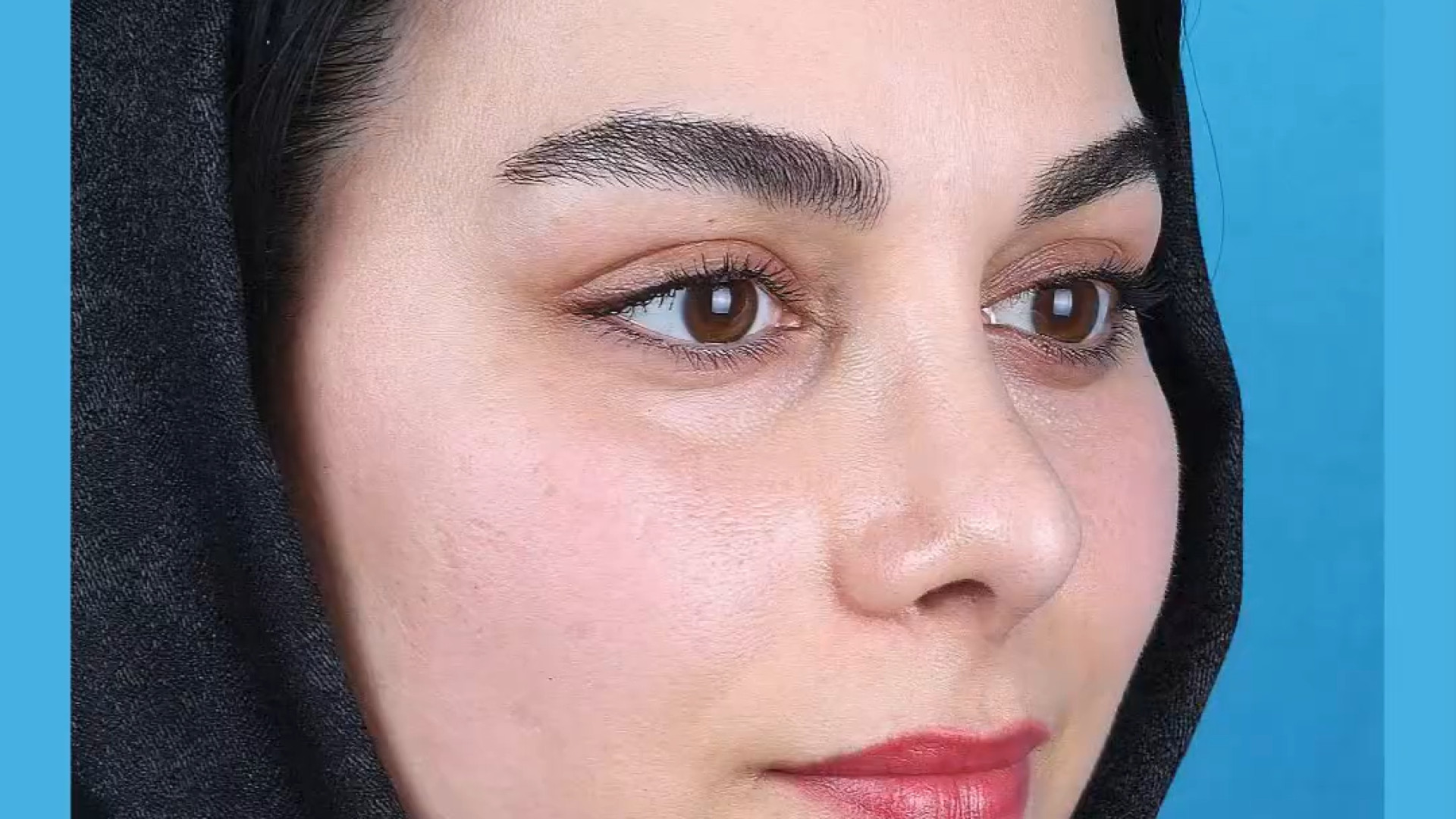 نمونه ی رینوپلاستی گوشتی دکتر علی جمشیدی