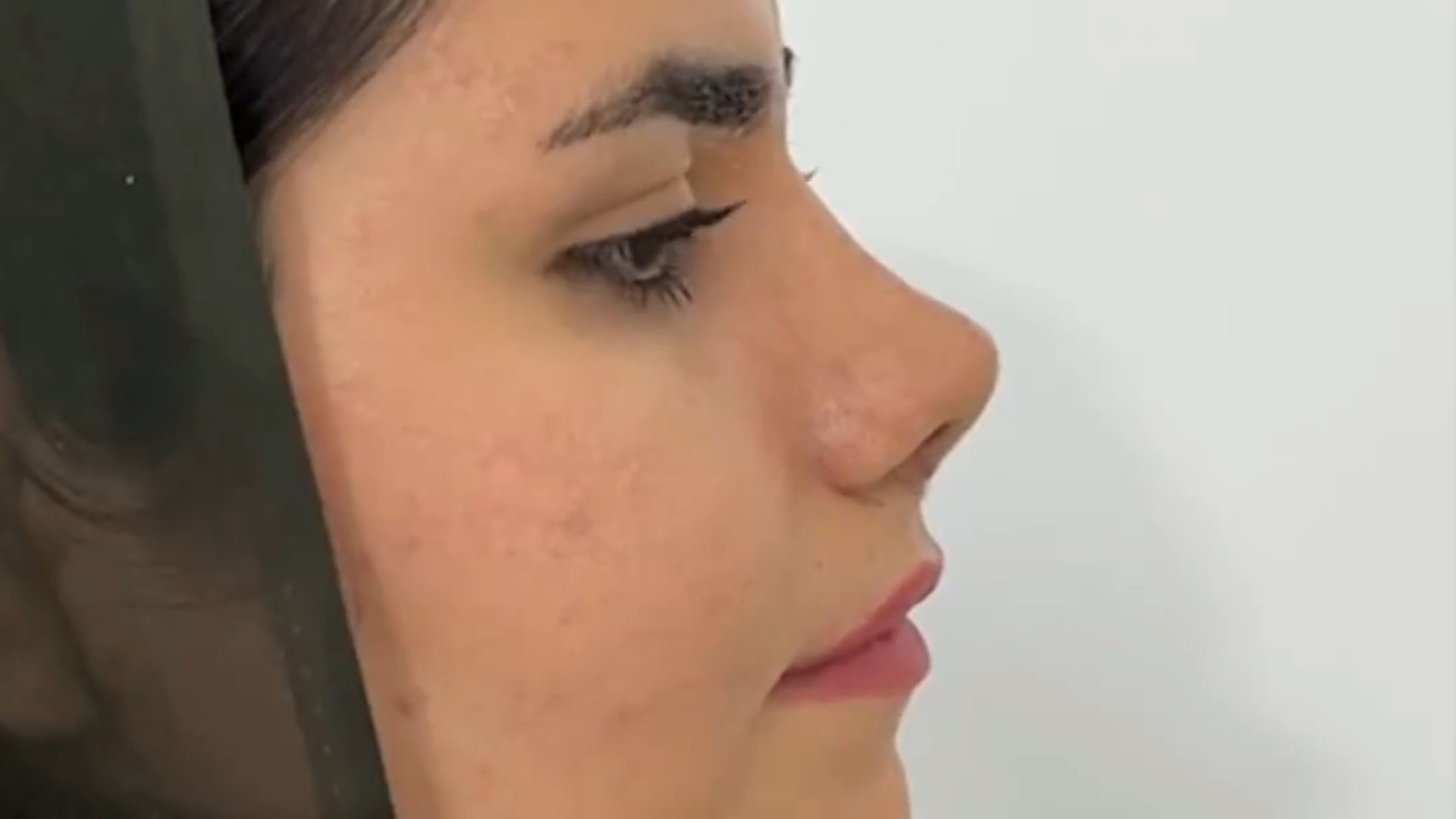 عمل بینی توسط دکتر علی جمشیدی دکتر علی جمشیدی