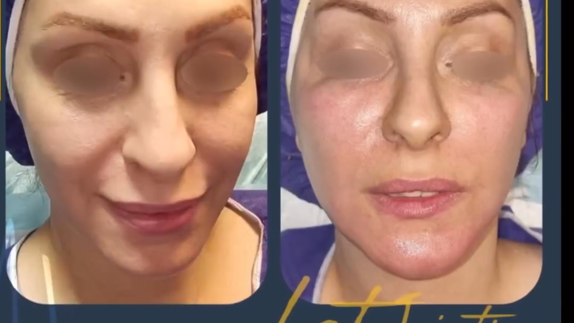قبل و بعد تزریق چربی دکتر آریا شفیعی