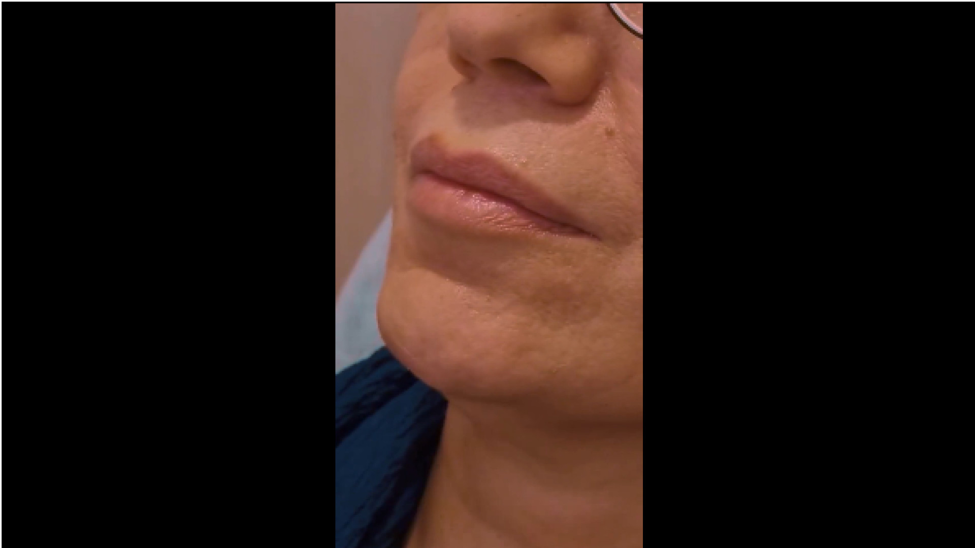 فیلم تزریق فیلر چانه دکتر پروانه ساکت - متخصص پوست و مو، زیبایی