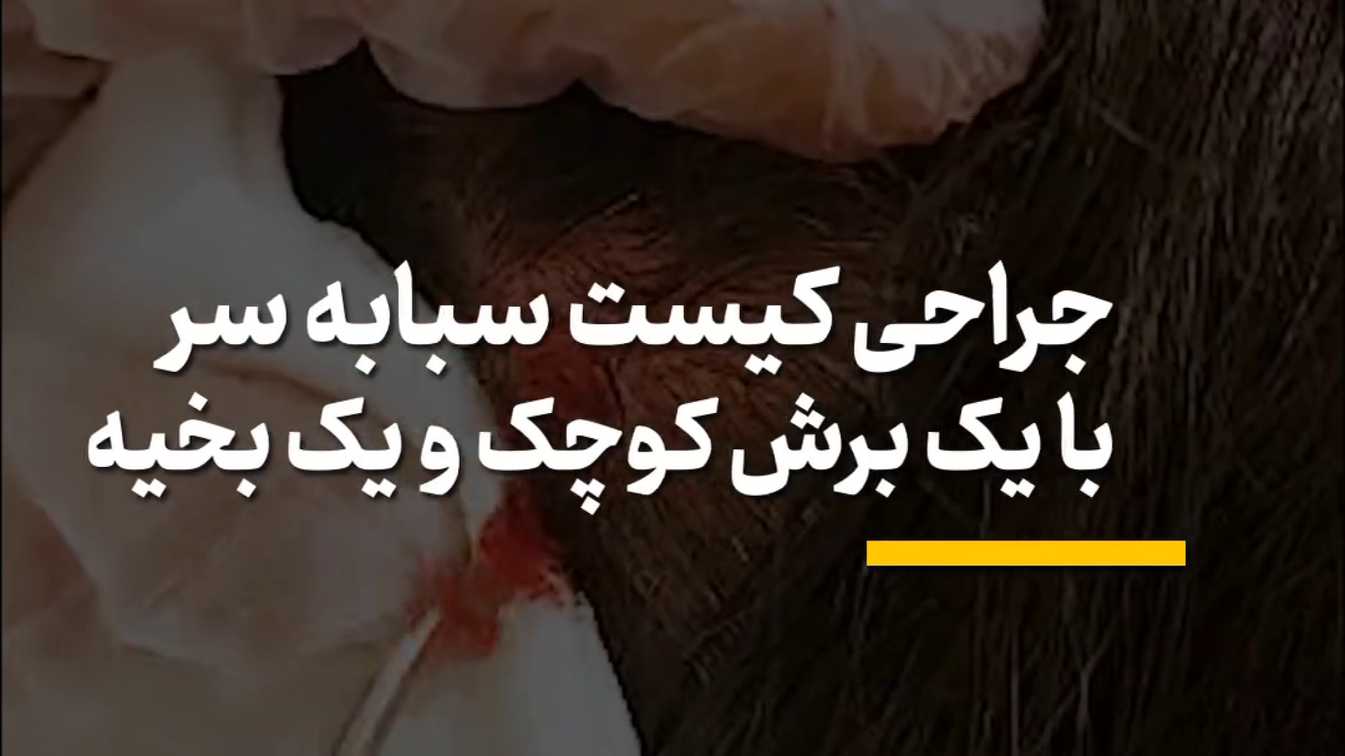 فیلم جراحی کیست سباسه سر دکتر پروانه ساکت - متخصص پوست و مو، زیبایی